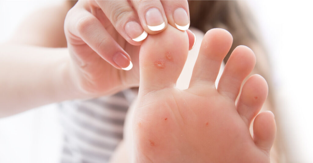 علاج مسمار الكعب بالحجامه